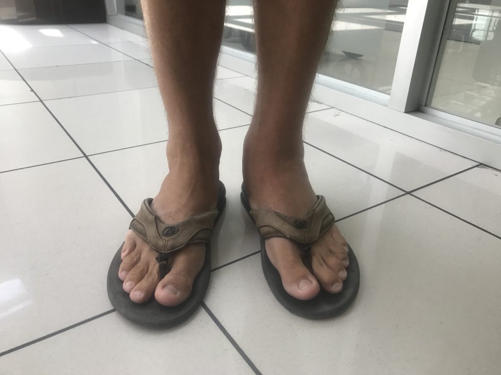 Matt's fat cankle