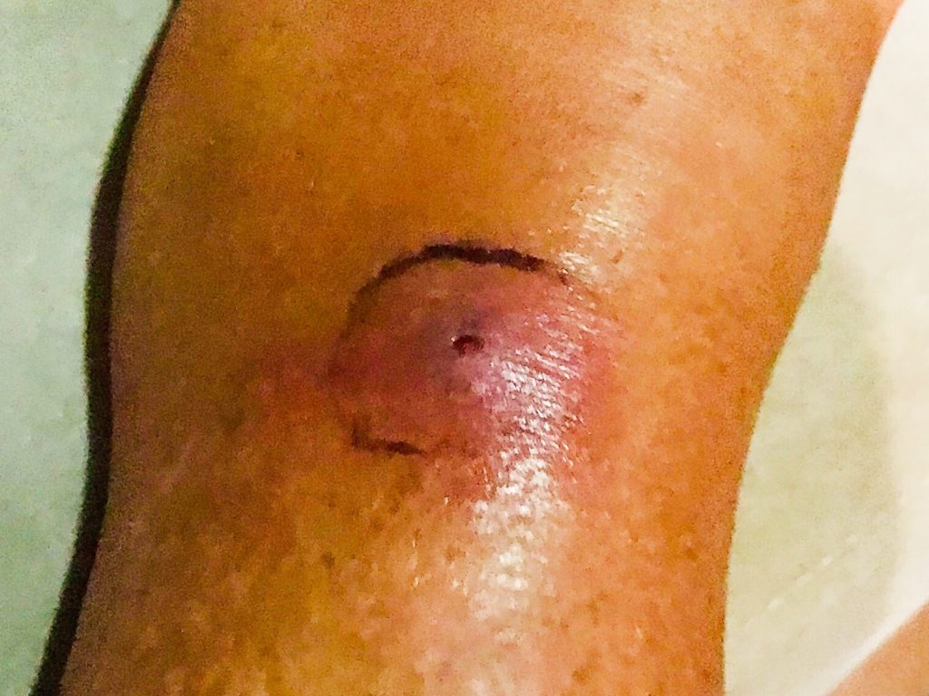 Initial bite, starting to get infected