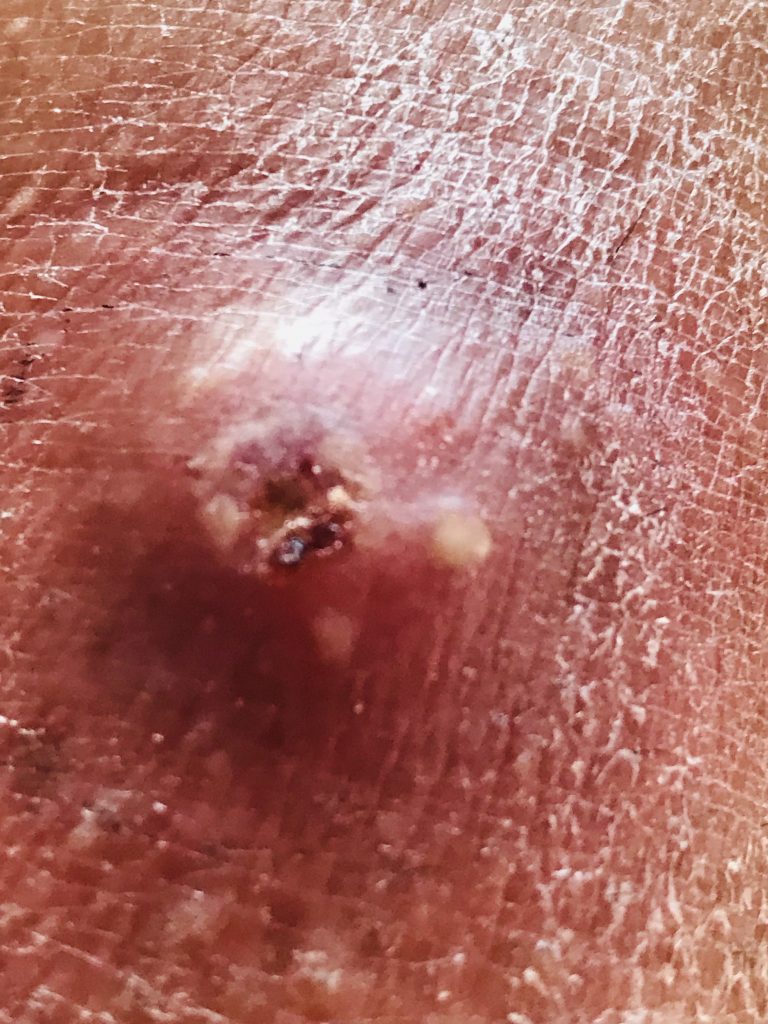 Infection is spreading and circle keeps getting bigger