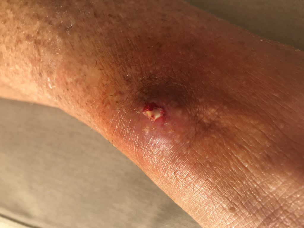 My body is trying so hard to fight the infection
