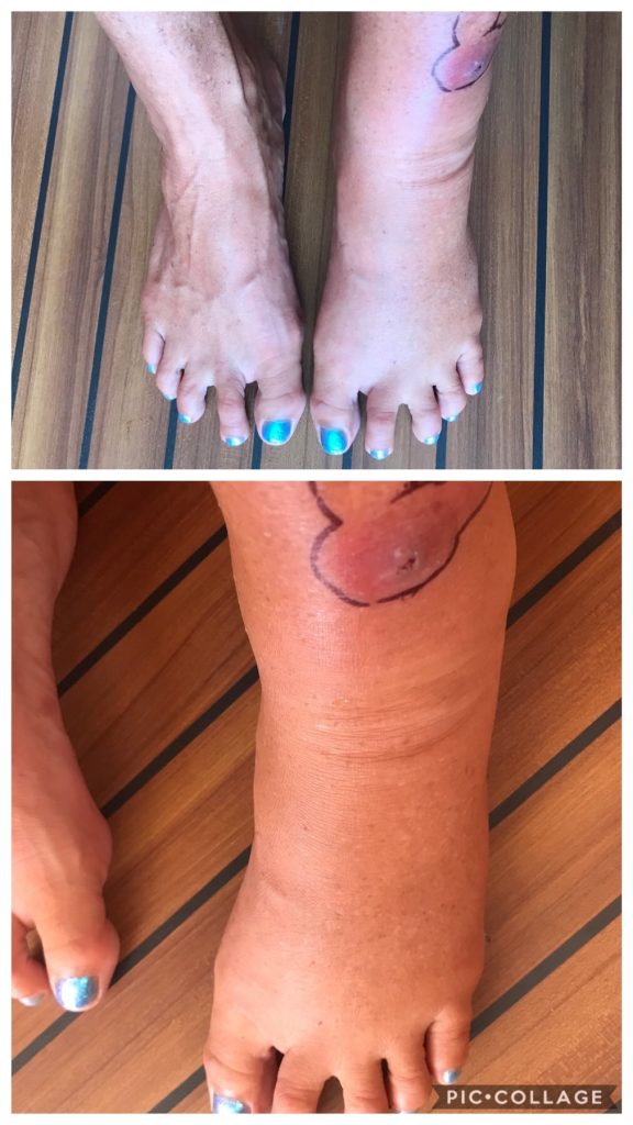 Infection spreading up my leg